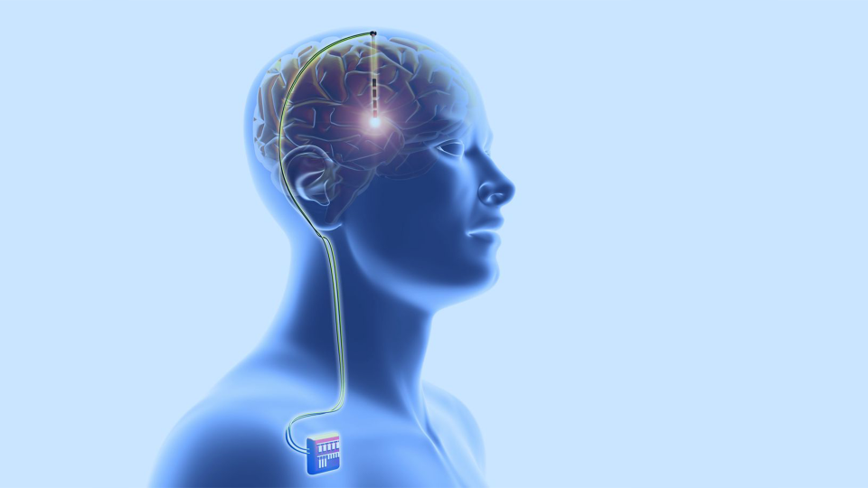 Deep Brain Stimulation