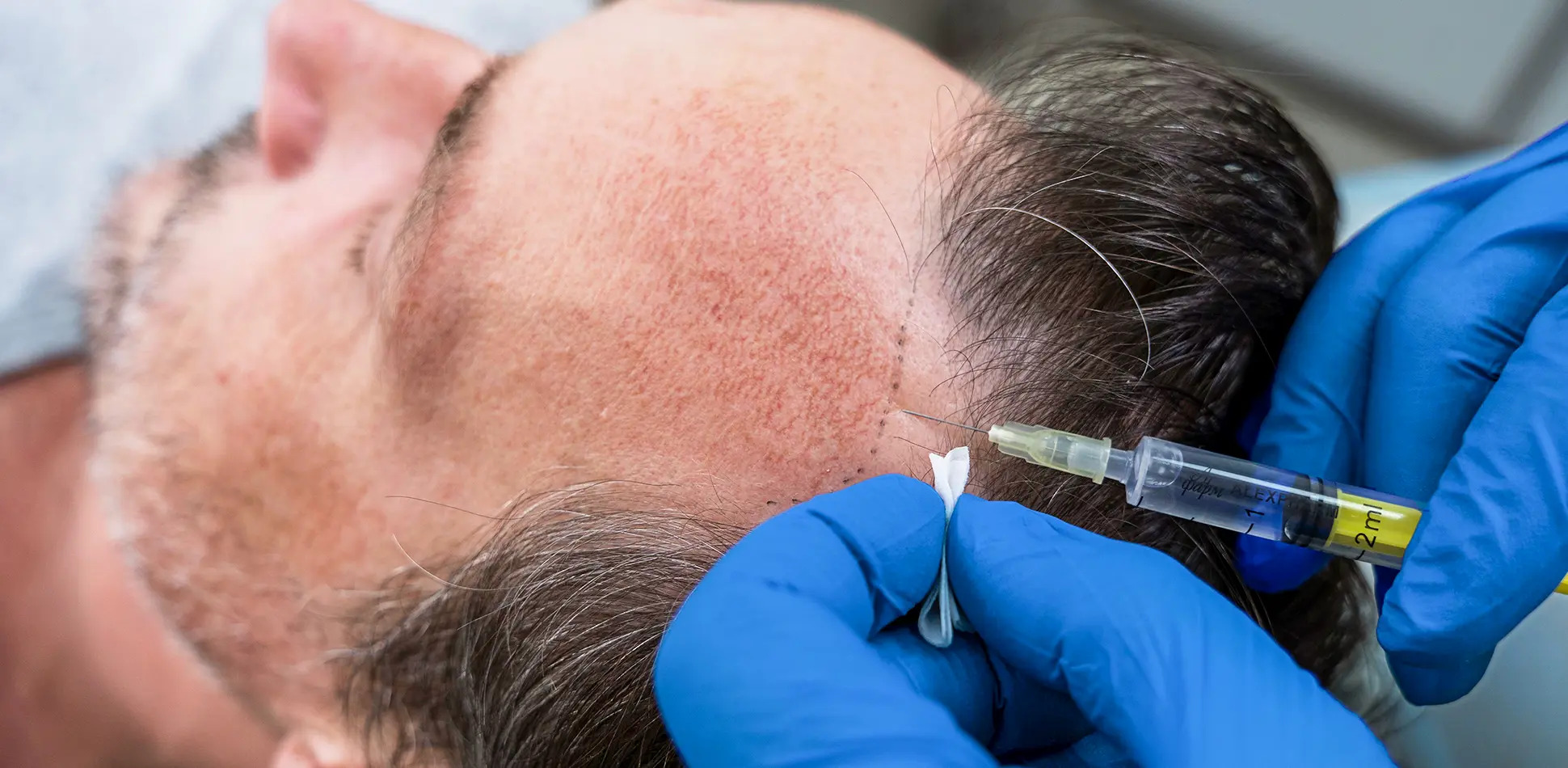 Hair Transplant